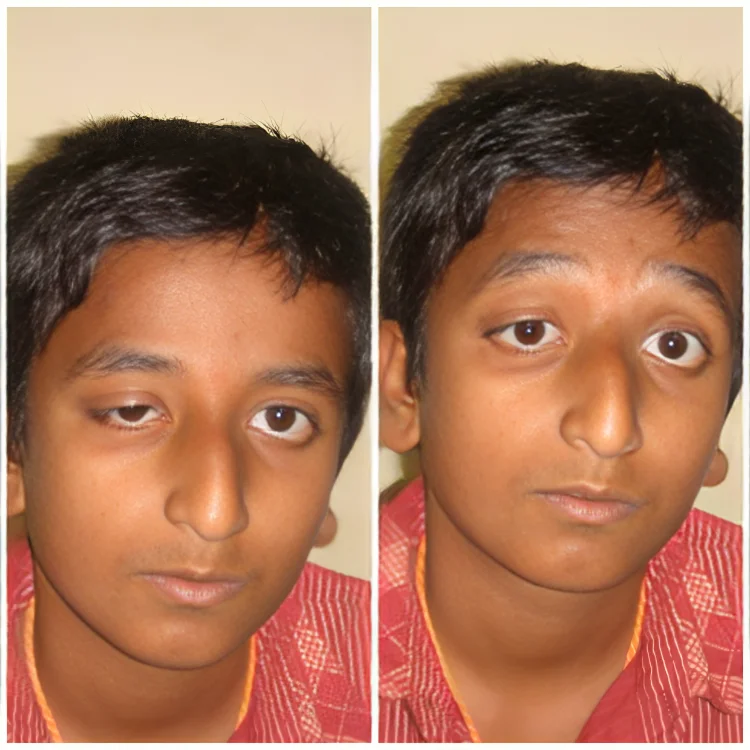 Oculoplasty-6